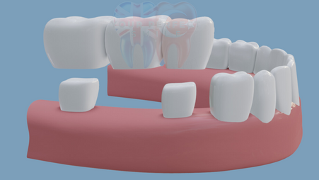 Gap Solutions with Dental Bridges | Reclaim Your Smile
