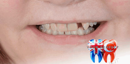 Durable Dental Bridges | Gap-Free Smiles Transformation