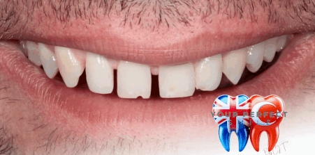Laser teeth whitening turkey treatment cheap UK consultation guaranteed warranty free help insured