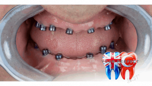 Zirconia Crowns for a Perfect Smile