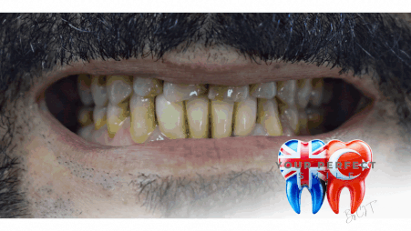 Natural-Looking Crowns | Seamless Smile Perfection