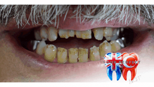 All-on-4 Dental Implants Success Story