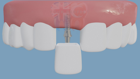 Permanent Dental Implants | Rejuvenate Your Smile