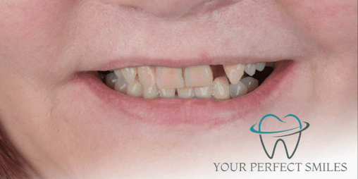 Your Perfect Smiles Implant Veneer Crown Hollywood Smile gif10