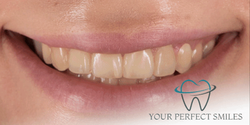 Your Perfect Smiles Implant Veneer Crown Hollywood Smile gif12