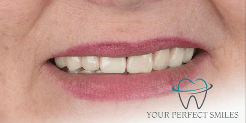 Your Perfect Smiles Implant Veneer Crown Hollywood Smile gif13