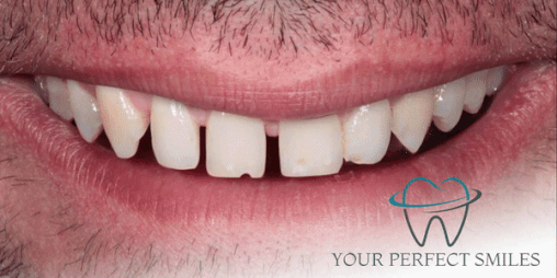 Your Perfect Smiles Implant Veneer Crown Hollywood Smile gif14
