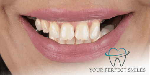 Your Perfect Smiles Implant Veneer Crown Hollywood Smile gif2