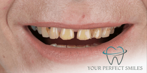 Your Perfect Smiles Implant Veneer Crown Hollywood Smile gif3