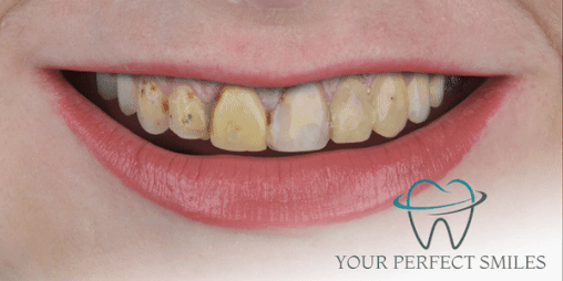 Your Perfect Smiles Implant Veneer Crown Hollywood Smile gif4