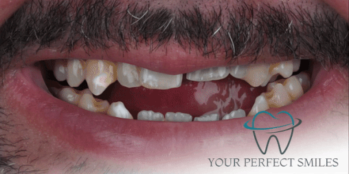 Your Perfect Smiles Implant Veneer Crown Hollywood Smile gif5