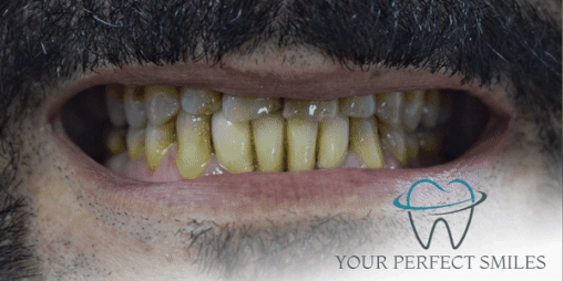 Your Perfect Smiles Implant Veneer Crown Hollywood Smile gif6