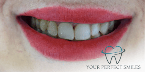 Your Perfect Smiles Implant Veneer Crown Hollywood Smile gif7