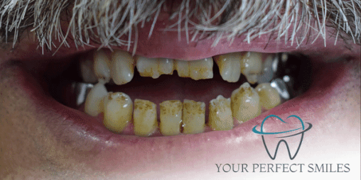 Your Perfect Smiles Implant Veneer Crown Hollywood Smile gif9